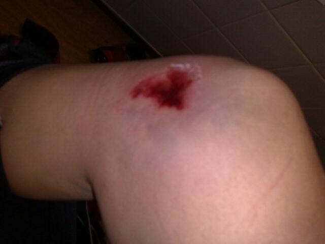 Tinks Knee